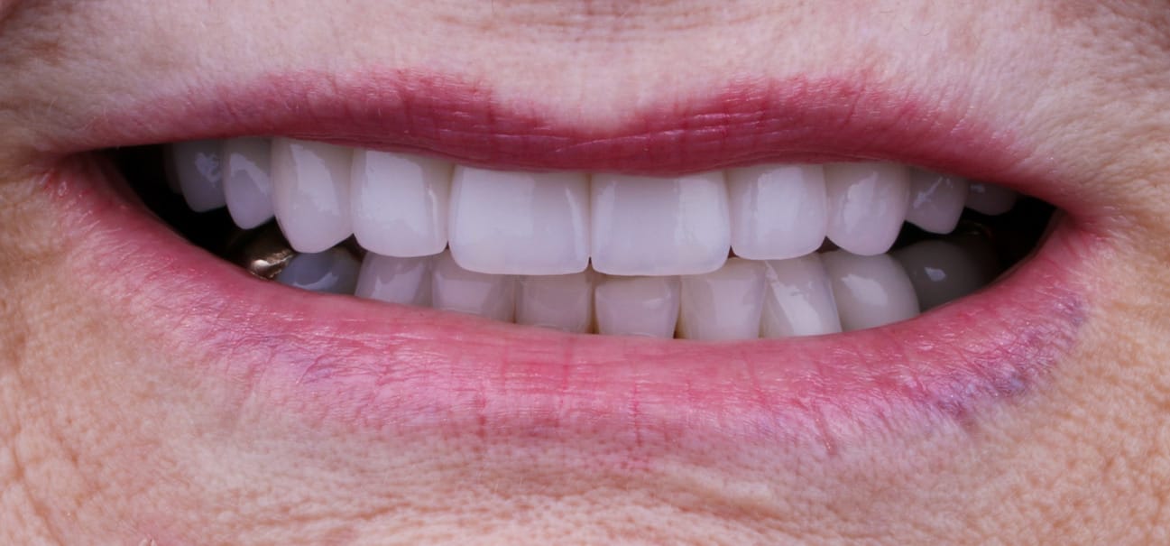 Anti-Aging Dentistry Before & After Gallery - Patient 55475040 - Image 4