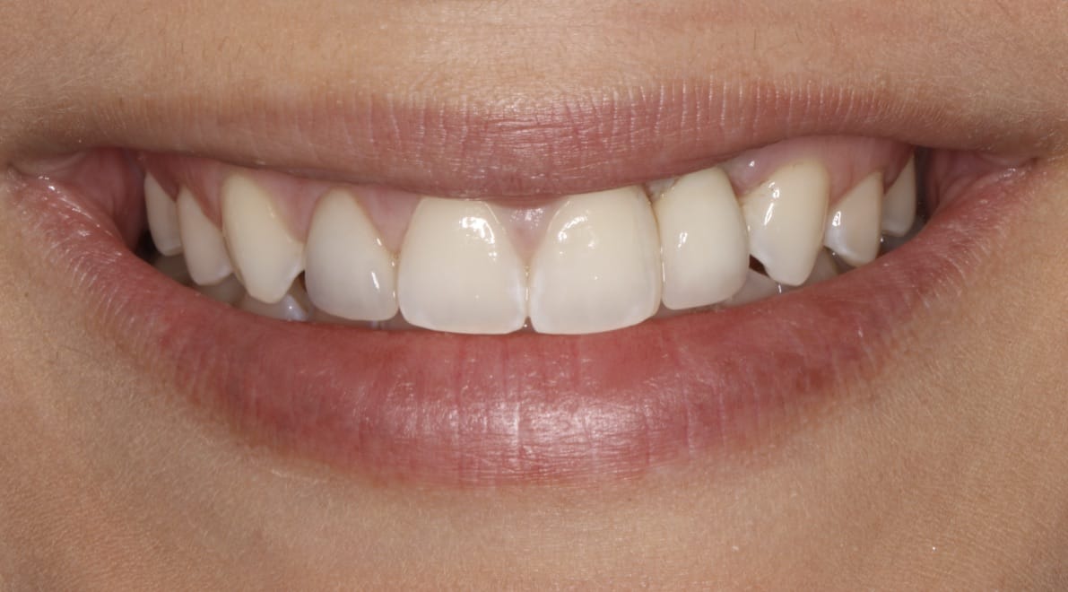 Implant Crown Before & After Gallery - Patient 55475044 - Image 2
