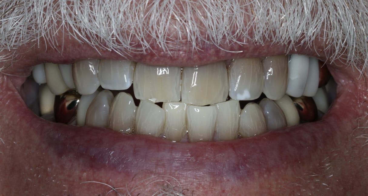 KOR Teeth Whitening Before & After Gallery - Patient 55475045 - Image 1