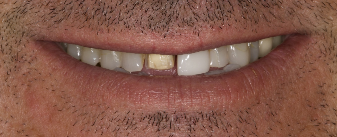 Anti-Aging Dentistry Before & After Gallery - Patient 191230835 - Image 1