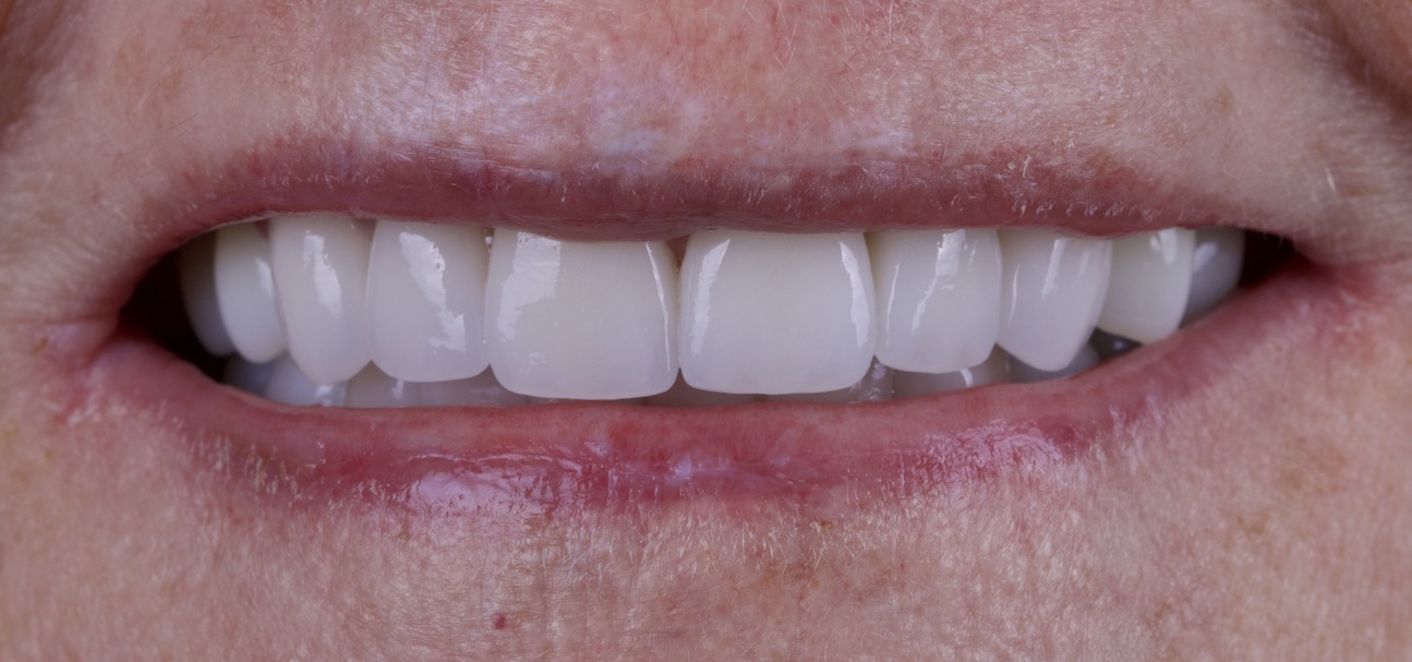 Anti-Aging Dentistry Before & After Gallery - Patient 191230836 - Image 2