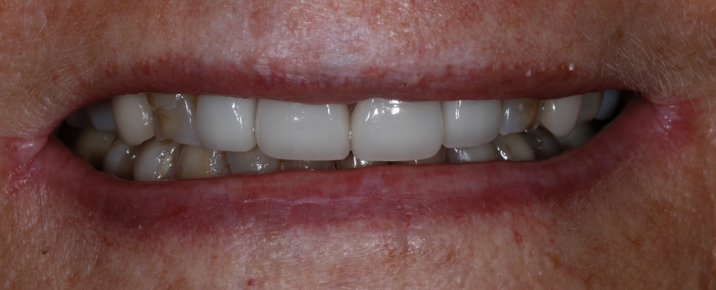 Anti-Aging Dentistry Before & After Gallery - Patient 191230836 - Image 1