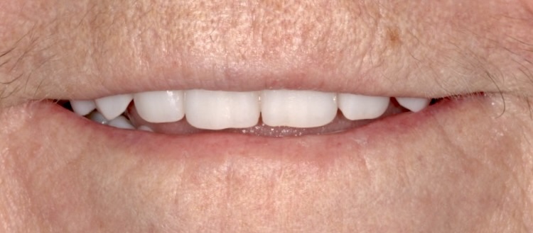 Anti-Aging Dentistry Before & After Gallery - Patient 191230839 - Image 2