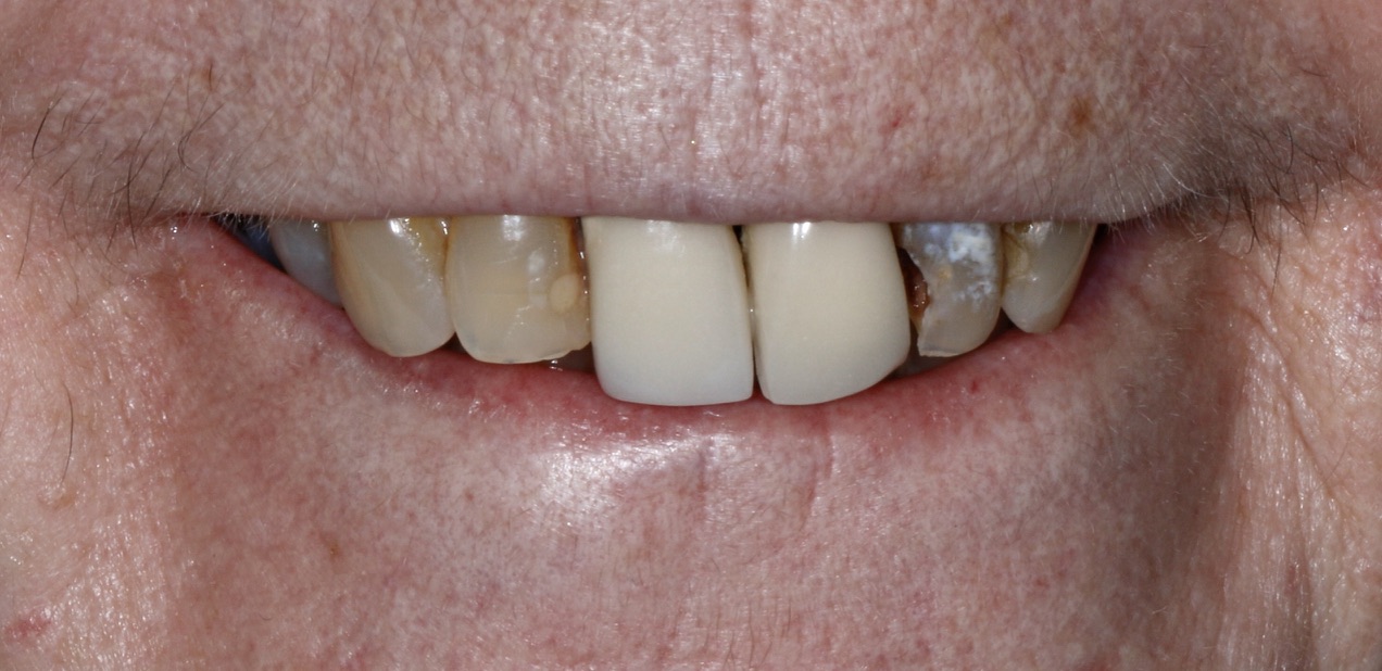 Anti-Aging Dentistry Before & After Gallery - Patient 191230839 - Image 1